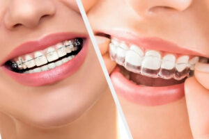 braces vs retainers: what you need to know