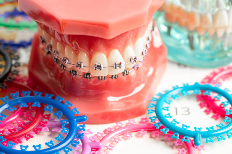Your Essential Guide to Braces: A Path to a Healthier, More Confident Smile