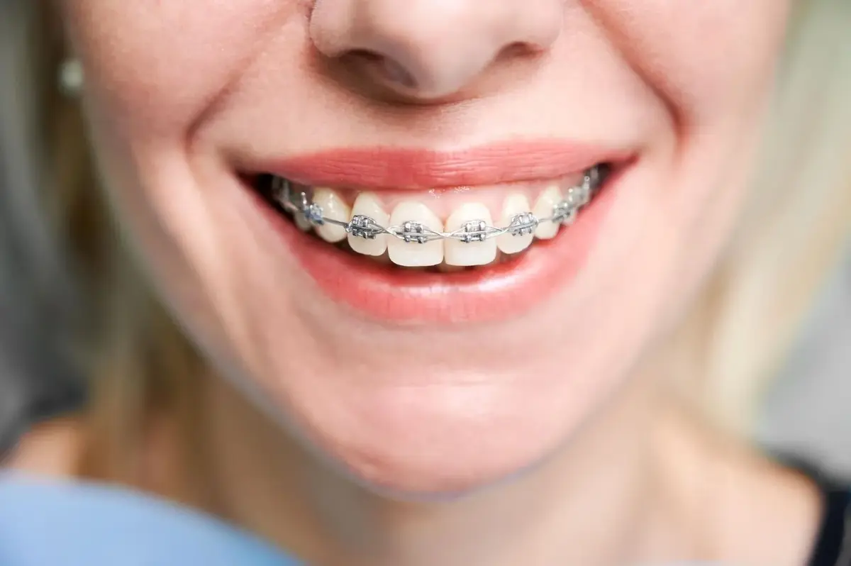 braces vs. retainers: what you need to know