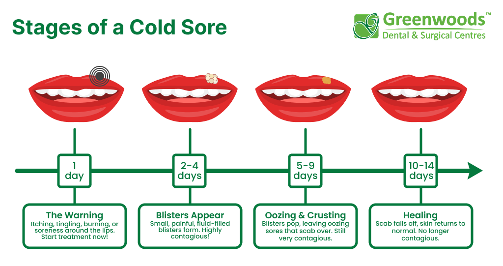 Cold Sore Corner Of Mouth Stages
