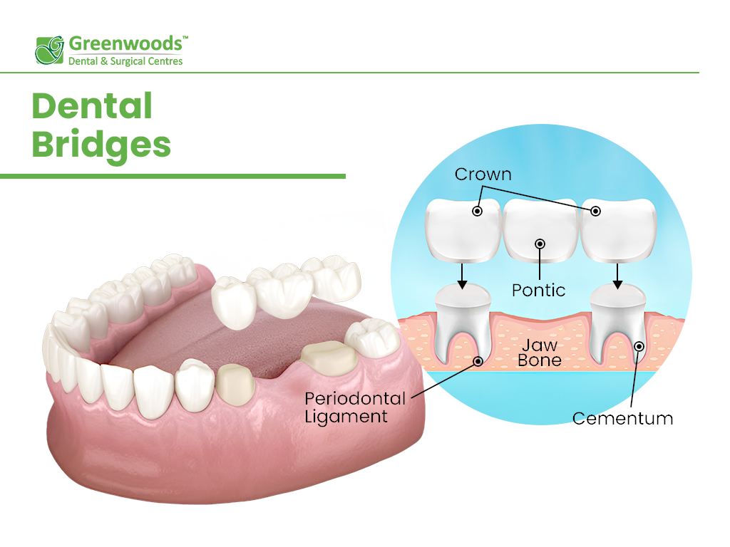 Scheme of dental bridges