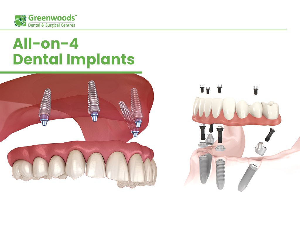 Scheme of All-on-4 Dental Implants