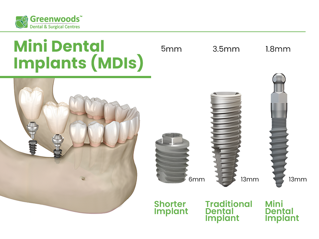 Scheme of Mini Dental Implants (MDIs)