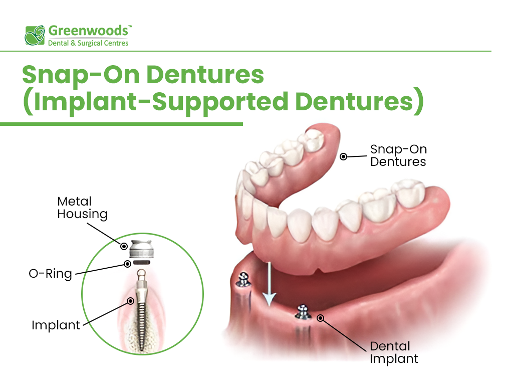 Scheme of Snap-On Dentures Implant-Supported Dentures