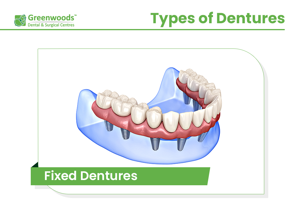 Fixed Dentures from dentist in Winnipeg