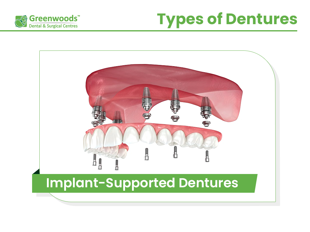 Implant-Supported Dentures at Greenwoods Dental Clinic in Winnipeg