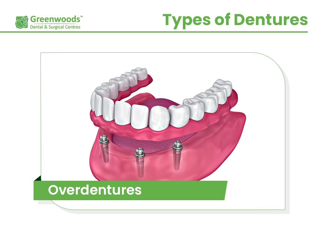 Overdentures from dentist in Winnipeg