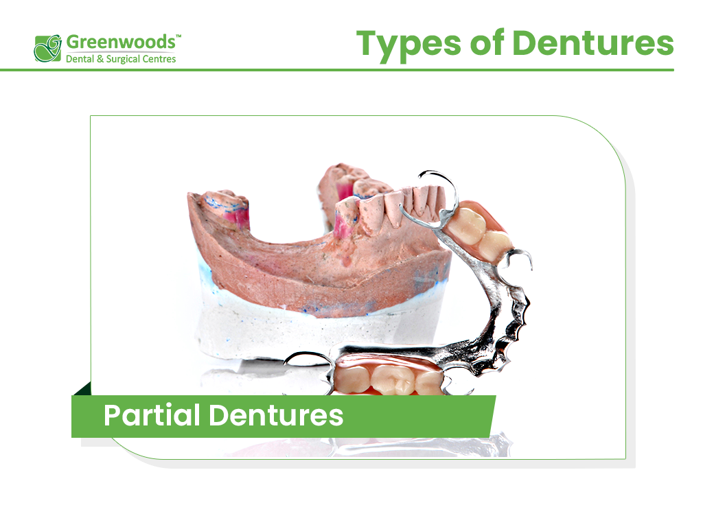 Partial Dentures at Greenwoods Dental Clinic in Winnipeg