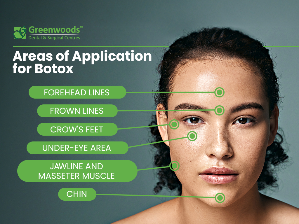 Scheme of application for botox treatment