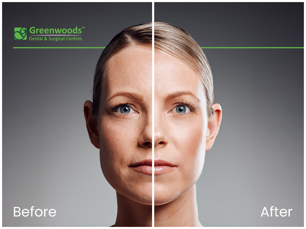 2 faces of woman before and after cosmetic botox treatment