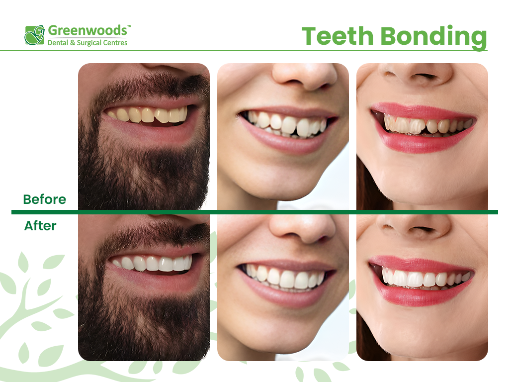 Teeth Bonding Before And After