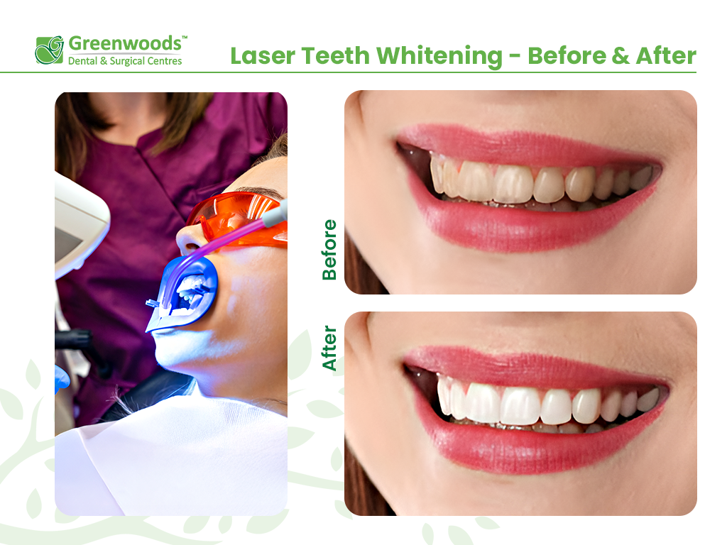 laser teeth whitening before and after procedure