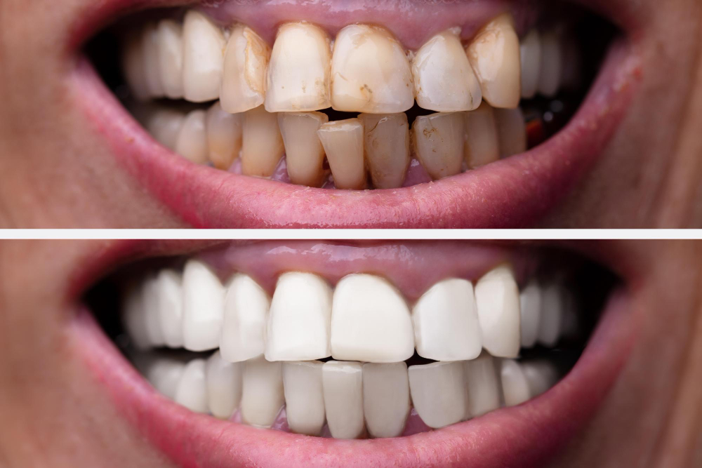 comparison of teeth shade after zoom teeth whitening 