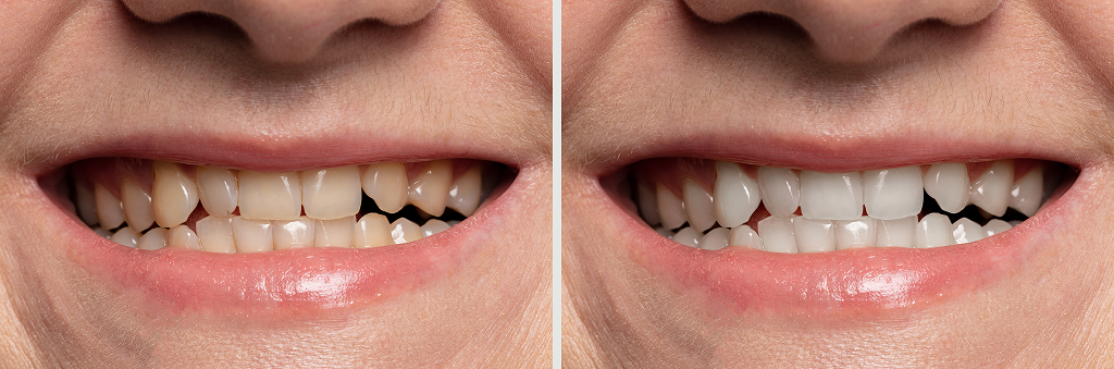 Before and After Professional Teeth Whitening in Winnipeg