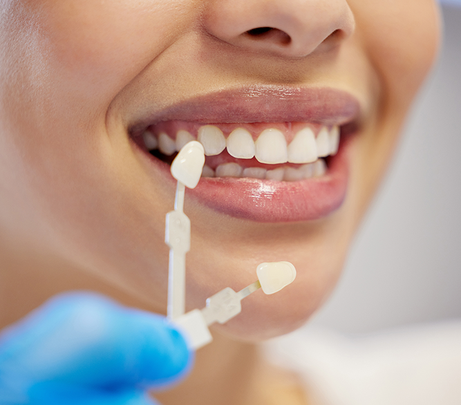 Veneers Options