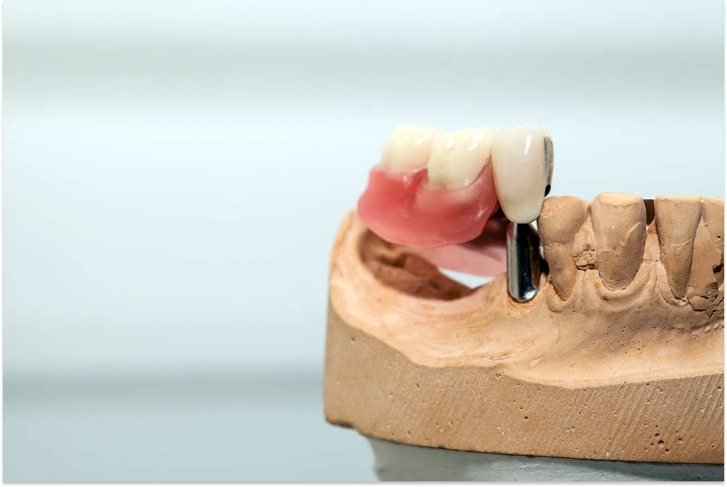 Dental Bridge on Artificial Jaw