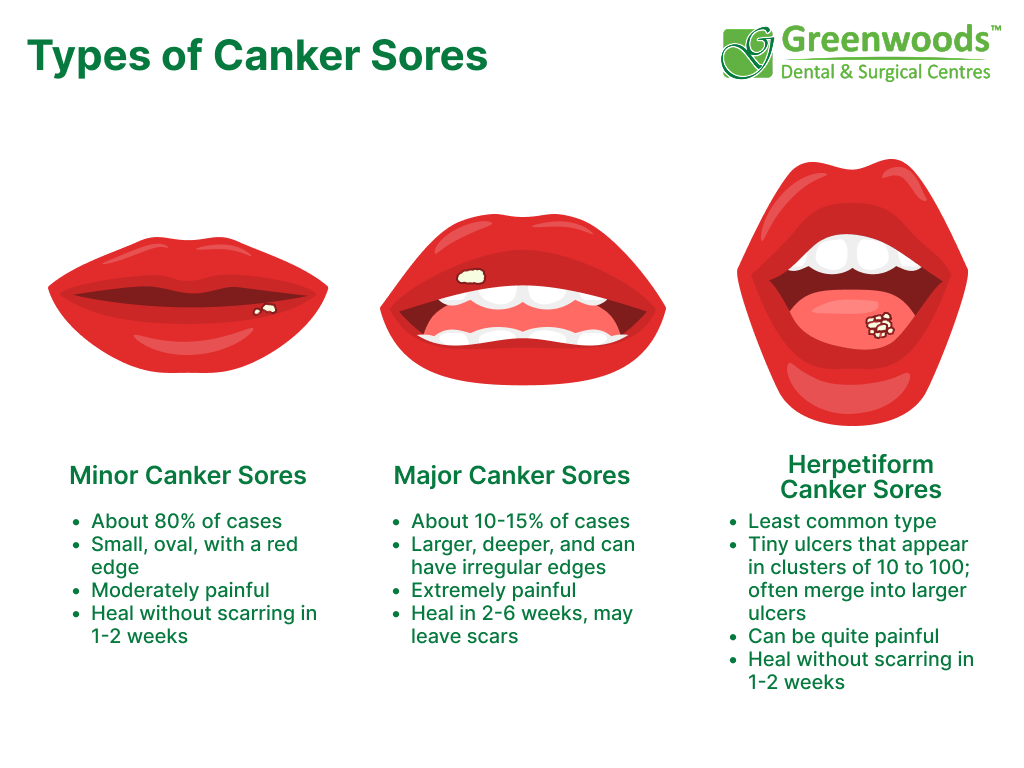 Canker Sore Treatment Causes Greenwoods Dental Blog