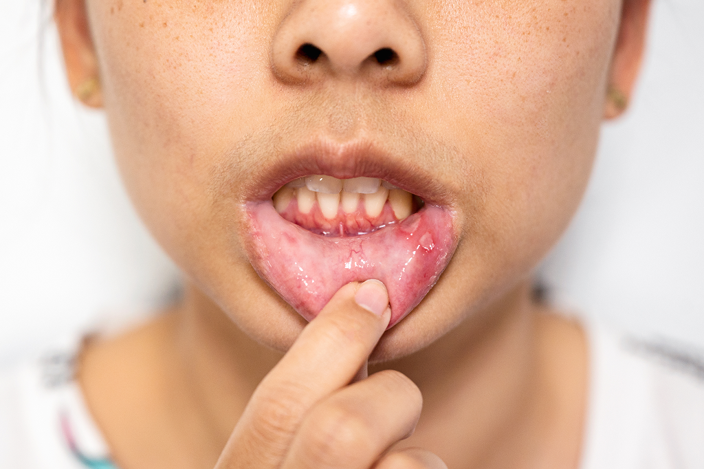 Decoding Canker Sores: Your Essential Guide