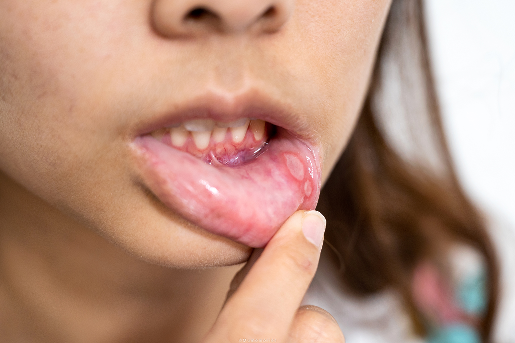 Woman with canker core or Aphthous ulcer
