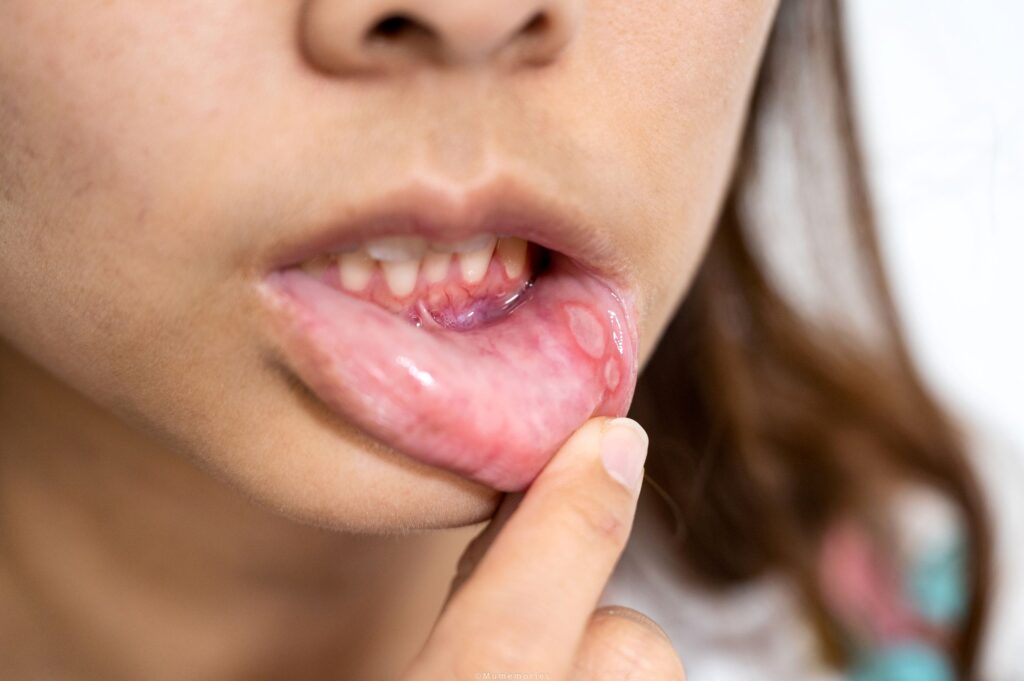 woman with a canker sore