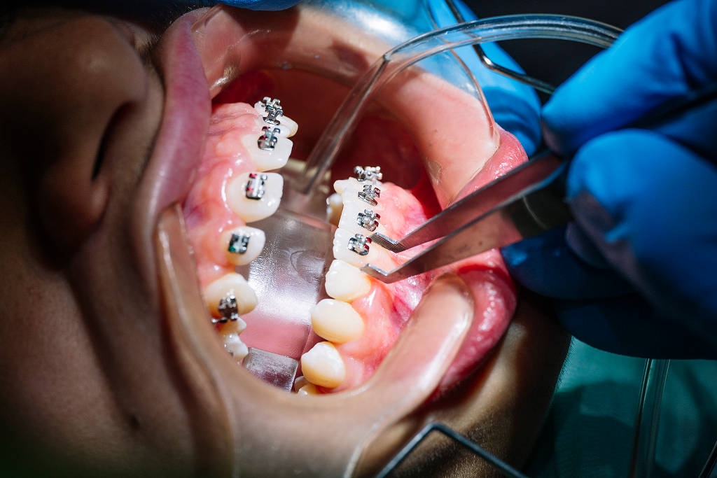 A dentist placing a braces bracket on a patient's teeth in a dental office