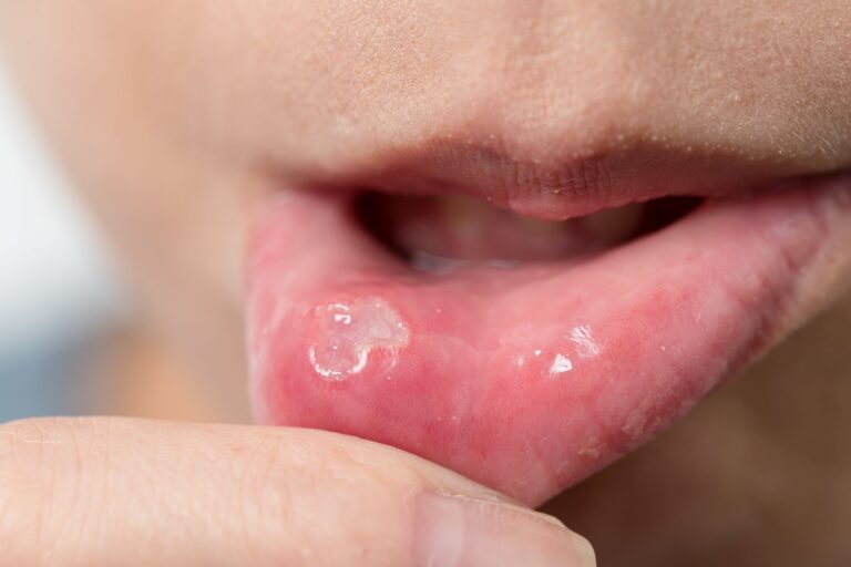 Decoding Canker Sores: Your Essential Guide