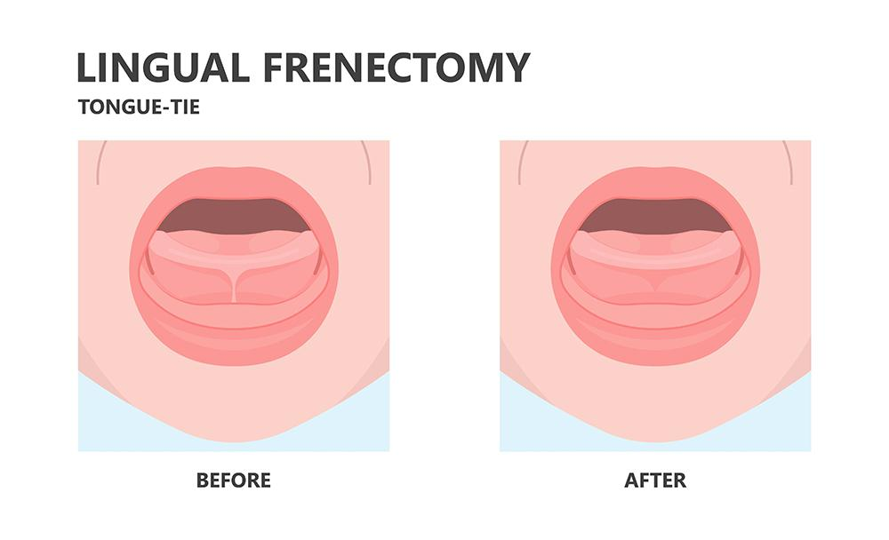 Before and after frenectomy