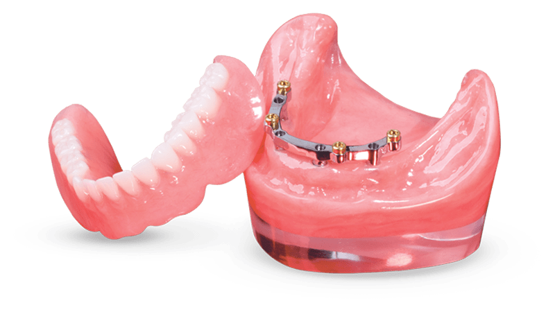 Bar Dentures Winnipeg