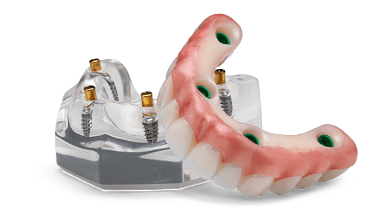 Implant Supported Dentures