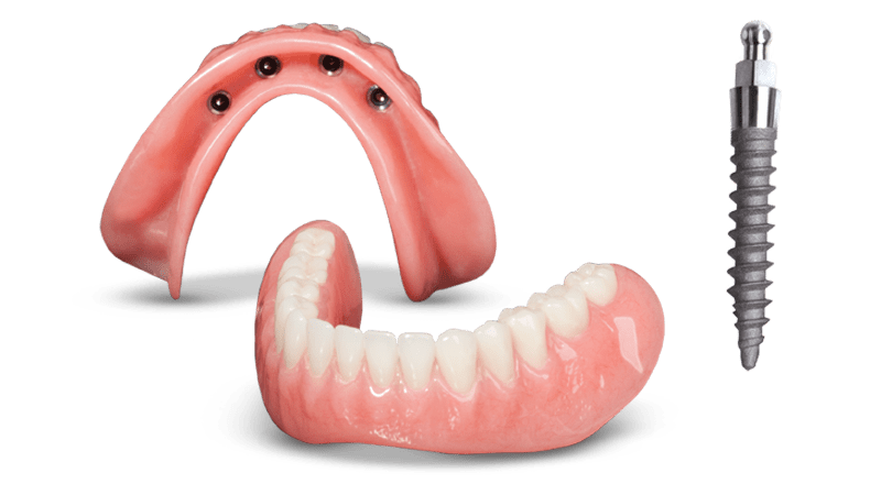 Implant Support Overdenture