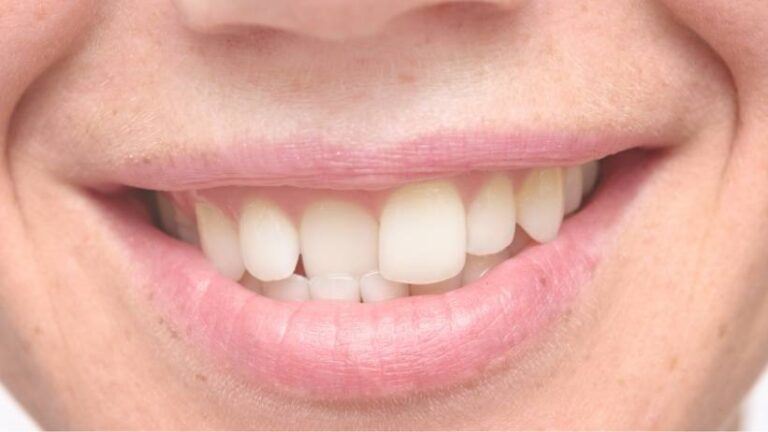 How to Fix a Snaggletooth: Causes, Problems, and Treatments