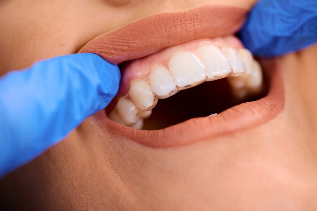 Patient at Greenwoods Dental Centre getting her Invisalign