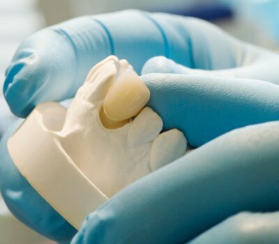 tooth-colored restorations in winnipeg - doctor holding a composite filling