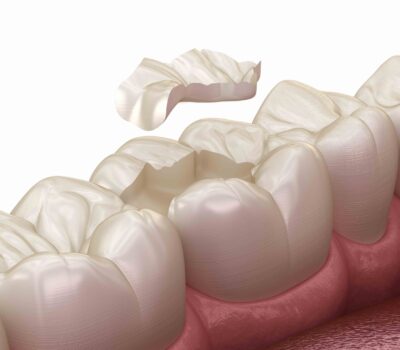 Inlays and outlays in Winnipeg