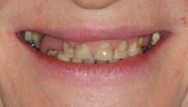 Before prosthodontic treatment