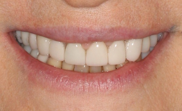 After prosthodontic treatment