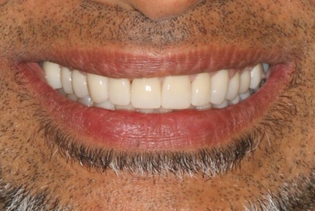 After prosthodontic treatment