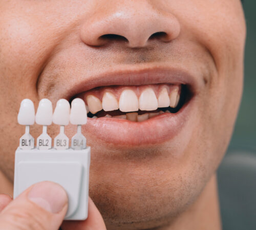 Doctor showing dental veneers to the patient