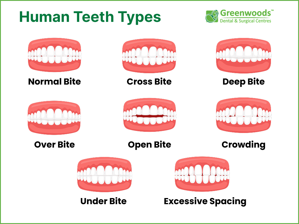 Types of Dental bites 