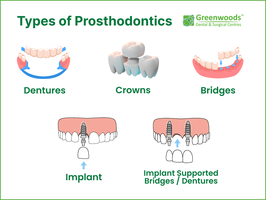 Illustrations showing different types of Prosthodontics 