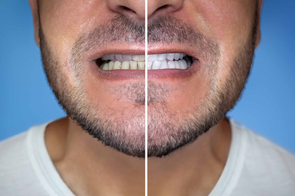 before and after after a full-mouth reconstruction