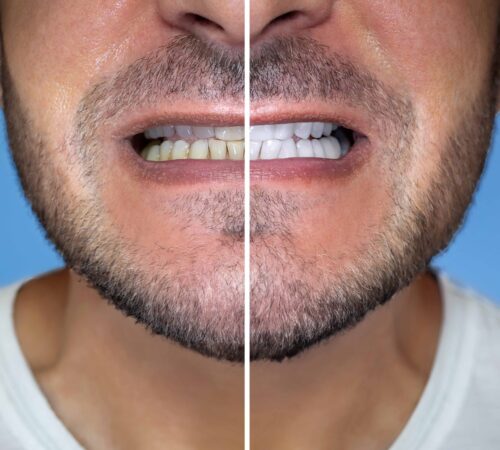 before and after after a full-mouth reconstruction