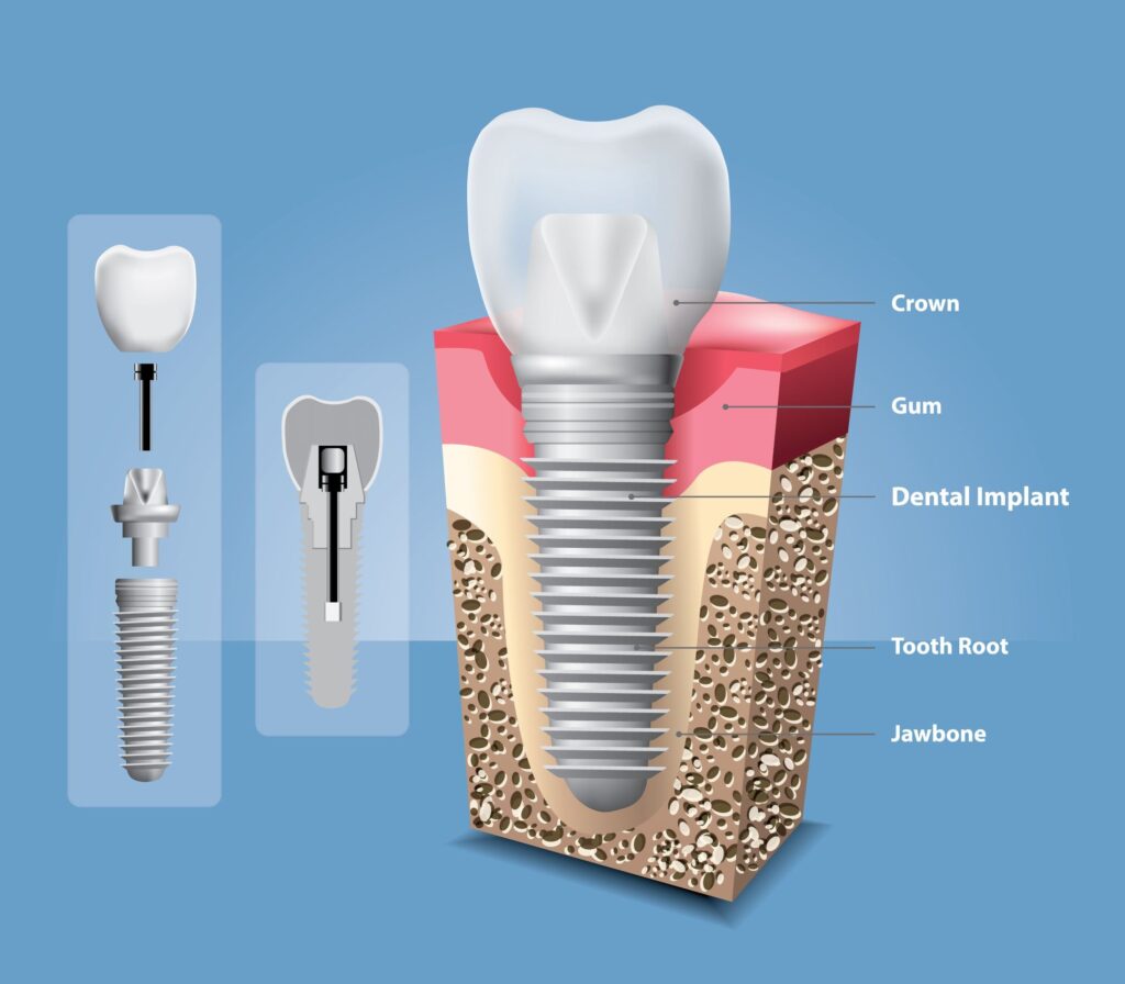 illustration on dental implants