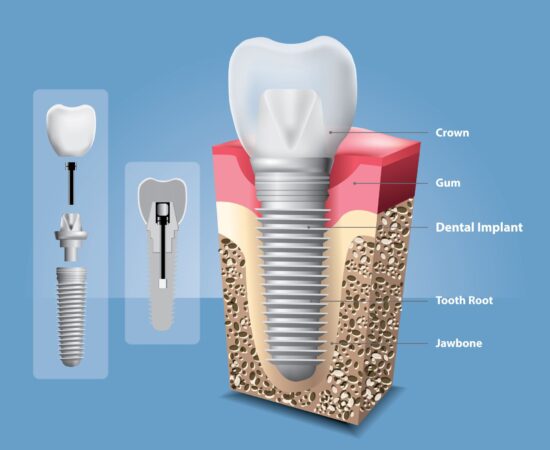 illustration on dental implants