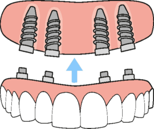 all-on-4 dental implants