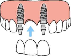dental bridge implant