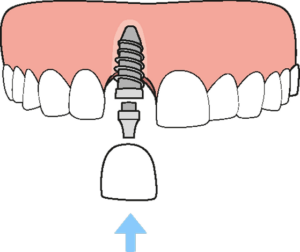 single tooth dental implant
