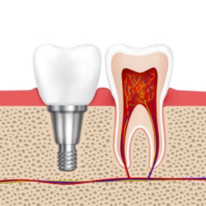 implants dental implants