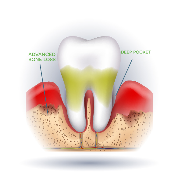 Advanced Periodontitis - Severe Gum Disease