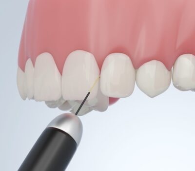 tooth reshaping & contouring